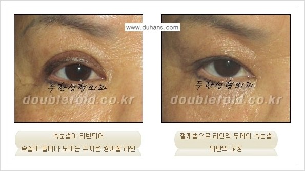 [두한성형외과 경쟁력 쌍꺼풀 재수술, 극한 재수술] - [속눈썹 외반 수술 방법 안내] 관련 이미지 8