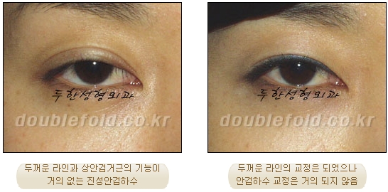 쌍꺼풀수술 두한성형외과 - 쌍커풀재수술의 문제점 관련 이미지 9