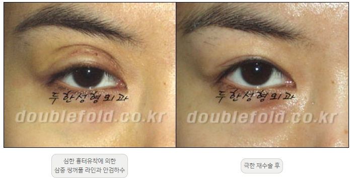 [Double Eyelid Surgery, Duhan Plastic Surgery] - [Extreme Revision Eye Surgery to Correct a Damaged Line] image 9