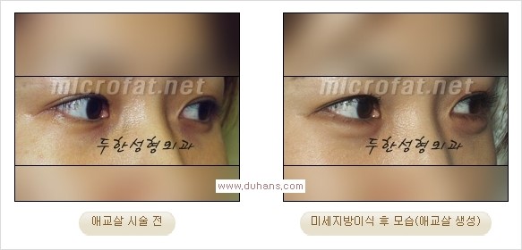 [두한성형외과 경쟁력 눈밑성형] - [타 병원 필러 애교살 시술 부작용을 미세지방이식으로 교정] 관련 이미지 14