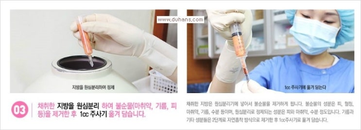 [두한성형외과 경쟁력 다크써클 치료] - [다크써클 + 눈위 지방이식 콤비 프로그램] 관련 이미지 8