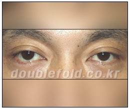 두한성형외과 쌍커풀재수술 - 삼중 쌍커풀 라인 교정 관련 이미지 3
