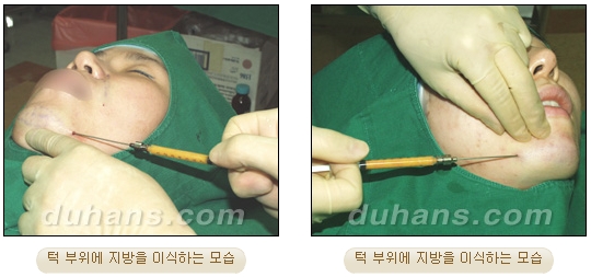 [Duhan Plastic Surgery Micro Fat Grafting] - [Receded Chin, Small Chin, Cleft Chin, Chin Line Asymmetry Correction] image 9