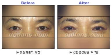 Blepharoplasty, Duhan Plastic Surgery - Upper and Lower Eyelids image 11