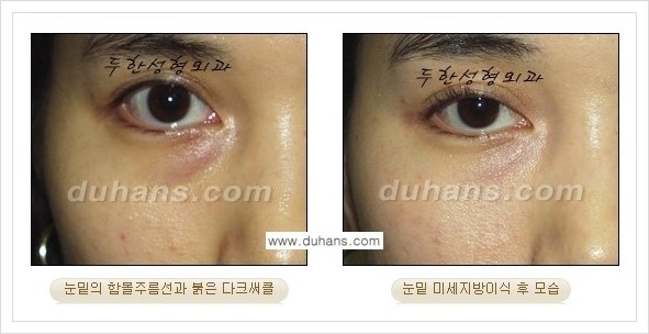 [두한성형외과 경쟁력 눈밑성형] - [꺼진 눈밑, 눈밑 함몰 주름선 눈밑 미세지방이식 안내] 관련 이미지 11