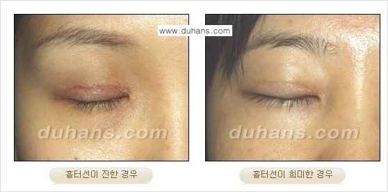 ​[두한성형외과 경쟁력 쌍꺼풀 재수술] - [아름다운 쌍꺼풀 선의 기준과 쌍꺼풀 재수술시 검사와 테스트 안내] 관련 이미지 5