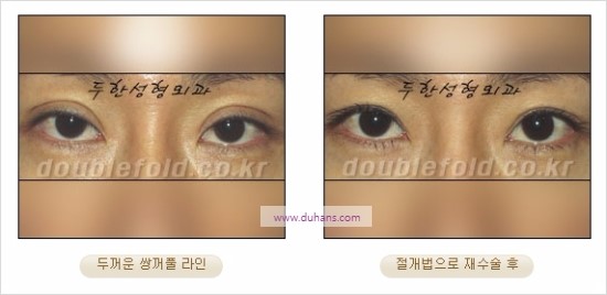 [두한성형외과 경쟁력 눈성형] - [쌍꺼풀 재수술에 대한 최선의 대안 제시] 관련 이미지 12