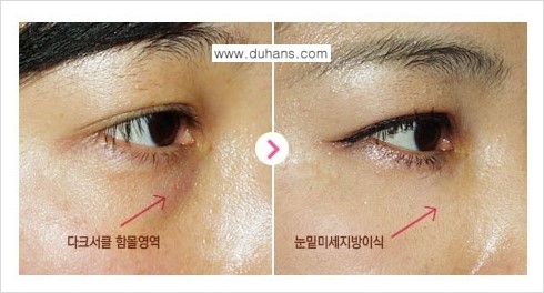 [두한성형외과 FOCUS 눈밑성형] - [다크써클의 치료방법 -  콜펫(Col-fat) 눈밑 미세지방이식 ①] 관련 이미지 3