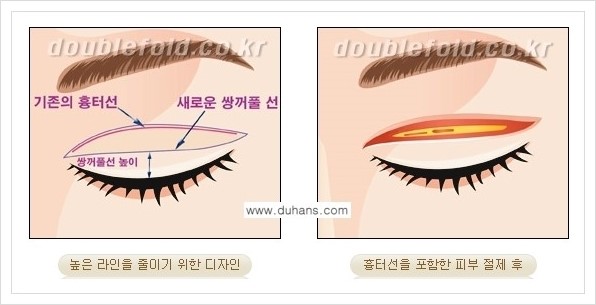 [두한성형외과 경쟁력 쌍꺼풀 재수술] - [두껍고 어색한 라인 교정하는 방법 안내 1.] 관련 이미지 8