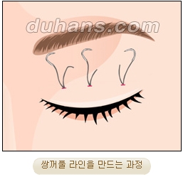 눈성형잘하는곳 두한성형외과 - 겹쌍꺼풀 관련 이미지 13