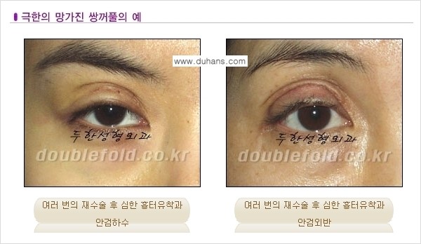 [두한성형외과 경쟁력 쌍꺼풀 재수술, 극한 눈재수술] - [망친 쌍꺼풀을 복원하는 극한 눈재수술] 관련 이미지 1