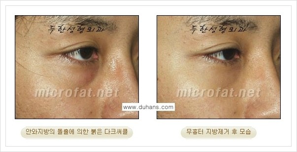 [두한성형외과 경쟁력 눈밑성형] - [눈밑지방제거, 눈위지방제거 안내 2.] 관련 이미지 20
