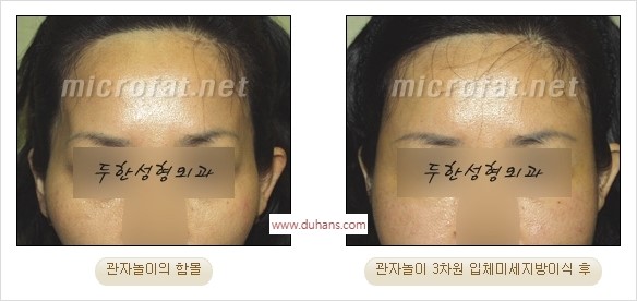 [두한성형외과 경쟁력 지방이식] - [두한 자가지방이식 클리닉 안내]​ 관련 이미지 35