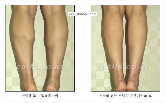 [두한성형외과 경쟁력 멀티종아리성형] - [지방흡입이 필요한 종아리 비만 안내] 관련 이미지 15