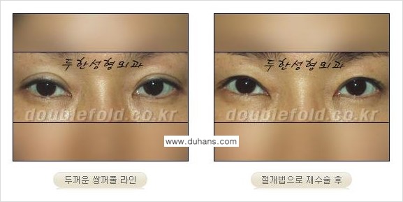 쌍꺼풀 재수술 Dr. 컬럼 관련 이미지 2