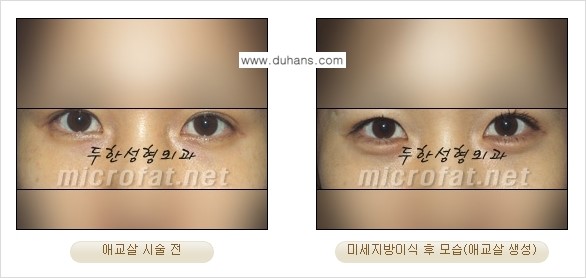 [두한성형외과 무한 경쟁력 눈밑성형] - [애교살 시술 1.] 관련 이미지 7
