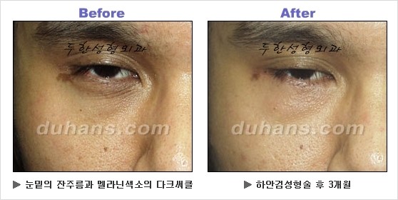 [두한성형외과 경쟁력 동안성형 리더] - ​[미간주름, 이마주름, 안검성형, 이마거상술, 눈썹거상술] 관련 이미지 102