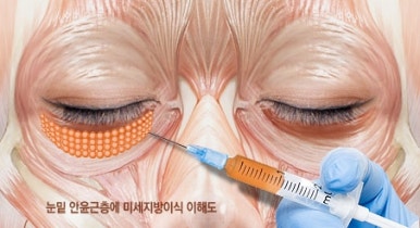[두한성형외과 다크서클] - [다크서클 콜펫지방이식] 관련 이미지 14