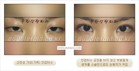 [두한성형외과 경쟁력 쌍꺼풀 재수술, 극한 눈재수술] - [안검하수(졸린 눈매)의 종류 안내] 관련 이미지 3