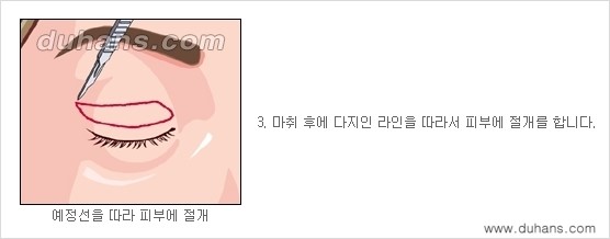 [두한성형외과 경쟁력 눈성형] - [상큼하고 환한 젊은 눈매 상안검성형(윗눈꺼풀 처짐) 안내] 관련 이미지 3