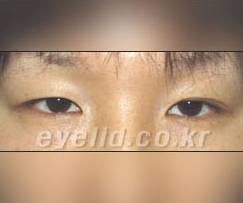 Duhan Plastic Surgery Eye Surgery - Are You a Candidate for Double Eyelid Revision Surgery?! image 10