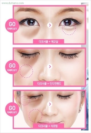 ​﻿[두한성형외과 경쟁력 눈밑성형] - [눈밑 다크써클 개선 방법] 관련 이미지 11