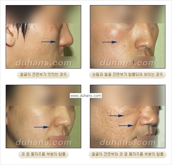⁠[두한성형외과 경쟁력 미세지방이식] - [귀족수술 - 입체미세지방이식 ①] 관련 이미지 3