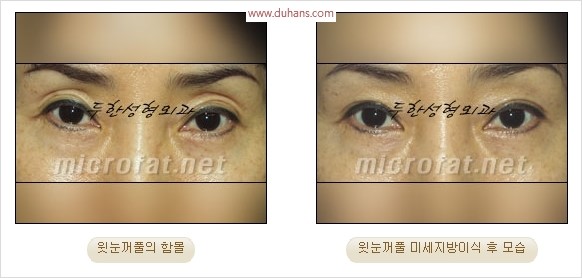 [두한성형외과 경쟁력 눈성형 리더] - [윗눈꺼풀 함몰( #꺼진눈꺼풀) 미세지방이식과 상안검성형]#꺼진눈성형 , #눈위함몰 관련 이미지 10