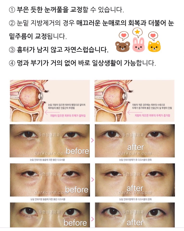 눈밑 지방제거, 눈밑 지방재배치 관련 이미지 3