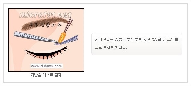 [두한성형외과 경쟁력 지방제거] - [눈 지방제거 안내] 관련 이미지 7
