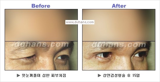 [두한성형외과 경쟁력 눈성형] - [상큼하고 환한 눈매! 상안검 성형(윗눈꺼풀 처짐) 안내] 관련 이미지 13