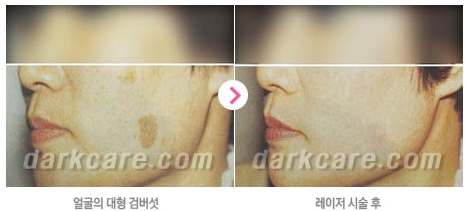 [두한성형외과 콤비프로그램] - [다크서클 + 검버섯 레이저] 관련 이미지 12
