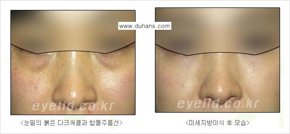 ​[두한성형외과 다크써클 치료] - [눈밑에 돌출이 있으면서 그 아래 함몰주름선이 있는 다크써클 증상] 관련 이미지 5