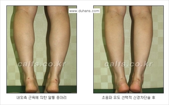 ​[두한성형외과와 날씬한 종아리 만들기!] - [간편하고 안전한 종아리 축소방법 ④] 관련 이미지 7