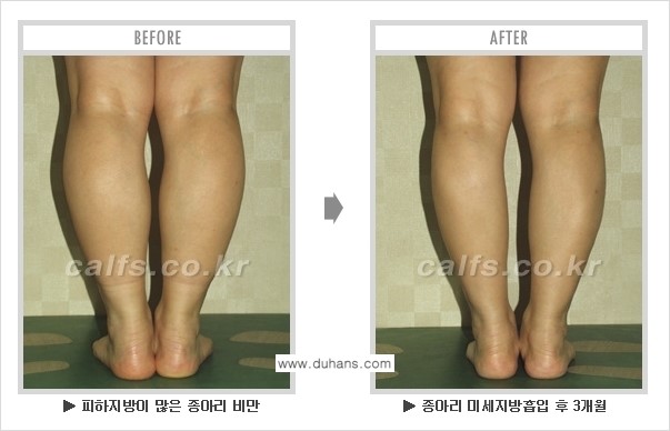 [두한성형외과 매력적인 종아리 만들기!] - [정교한 흡입 - 미세흡입관 지방흡입술 3.] 관련 이미지 7