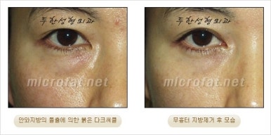 두한성형외과 눈밑수술 - 다크서클 수술 전후 관리 안내 관련 이미지 59