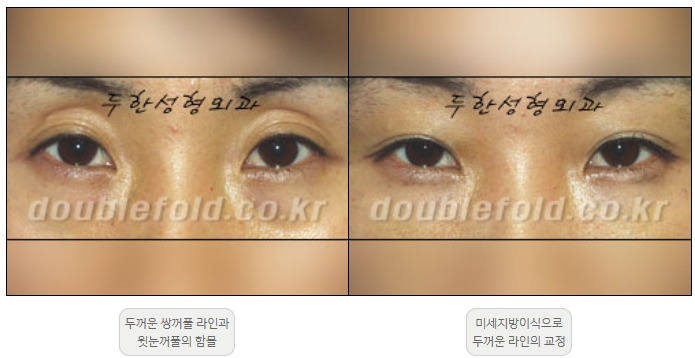 [Duhan Plastic Surgery Double Eyelid Revision] - [Thick Double Eyelid Line] image 19