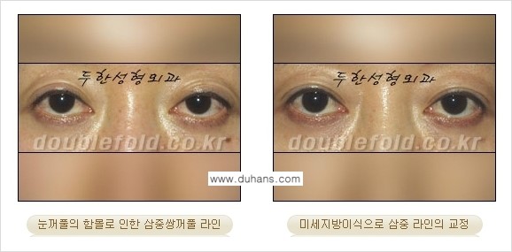 [두한성형외과 경쟁력 눈성형] - [미세지방이식으로 삼중 라인의 교정 방법 안내] 관련 이미지 5