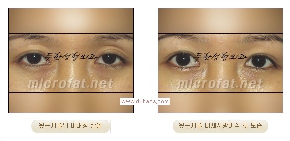 [두한성형외과 경쟁력 쌍꺼풀 재수술, 극한 눈재수술] - [어색한 쌍꺼풀 라인을 교정하는 윗눈꺼풀 미세지방이식] 관련 이미지 17