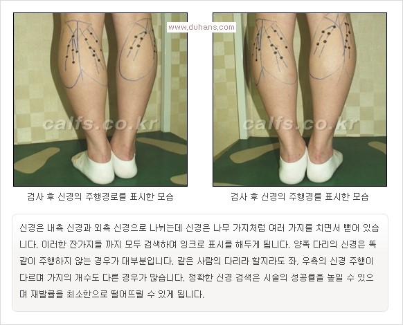 [두한성형외과 경쟁력 멀티종아리성형] -  [종아리 축소술의 여러 가지 종류] 관련 이미지 13
