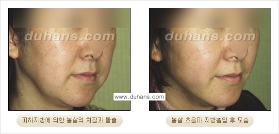 ​​​﻿[두한성형외과 경쟁력 간편지방흡입] - [볼살지방흡입, 턱선지방흡입 안내] 관련 이미지 8