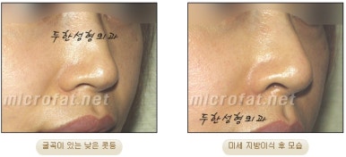 [Duhan Plastic Surgery Facial Fat Grafting] - [Fat Grafting Rhinoplasty] image 8