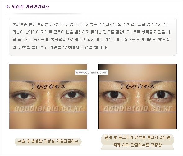 [두한성형외과 경쟁력 눈성형] - [안검하수(졸린 눈매) 재수술 안내 ①] 관련 이미지 7