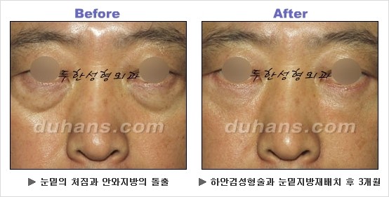 [두한성형외과 경쟁력 동안성형 리더] - ​[미간주름, 이마주름, 안검성형, 이마거상술, 눈썹거상술] 관련 이미지 83