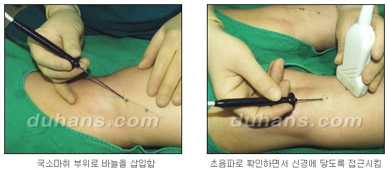 [두한성형외과 종아리축소술] - [초음파 유도 선택적 신경차단술 안내] 관련 이미지 11