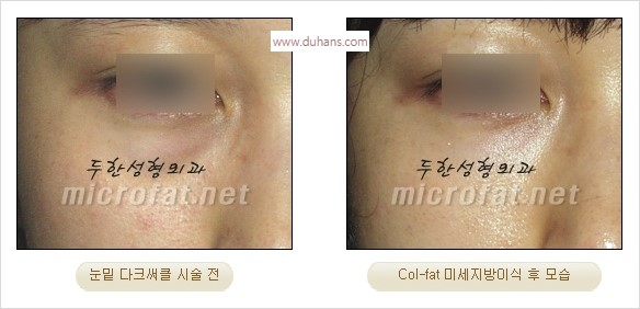 [두한성형외과 경쟁력 눈밑성형] - [다크써클 치료 전후 관리사항] 관련 이미지 23