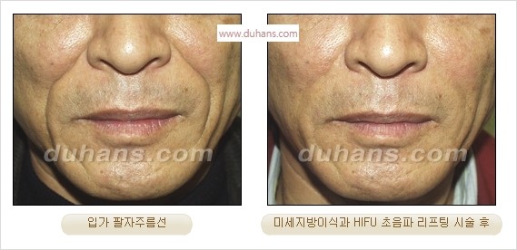 [두한성형외과 경쟁력 주름성형] - [주름제거를 위한 리프팅] 관련 이미지 58