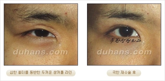 [두한성형외과 경쟁력 쌍꺼풀 재수술 리더 ] - [쌍꺼풀 재수술 과정, 쌍꺼풀 재수술 실패의 원인, 극한 재수술] 관련 이미지 16
