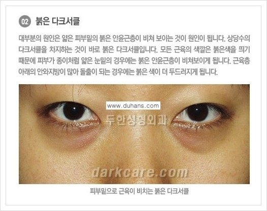 [두한성형외과 경쟁력 눈밑성형] - [다크써클의 종류] 관련 이미지 8