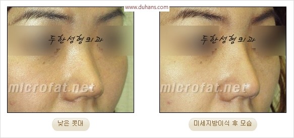 [두한성형외과 경쟁력 코성형 리더] - [자연스럽고 오똑한 콧망울! 코성형 방법]​ 관련 이미지 52